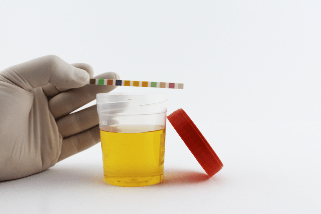 La importancia del examen general de orina en el diagnóstico&nbsp;renal