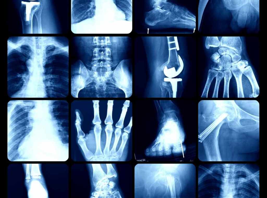 Tele de Tórax Digital: Avances en la Imagenología&nbsp;Médica