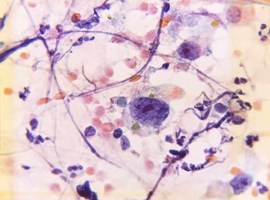 ¿Qué es el Examen de Papanicolaou y por qué es Importante para la Salud de las&nbsp;Mujeres?